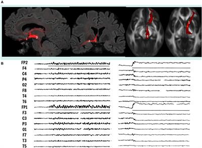 Deep Brain Stimulation Neuromodulation for the Treatment of Mood Disorders: Obsessive Compulsive Disorder and Treatment Resistant Depression